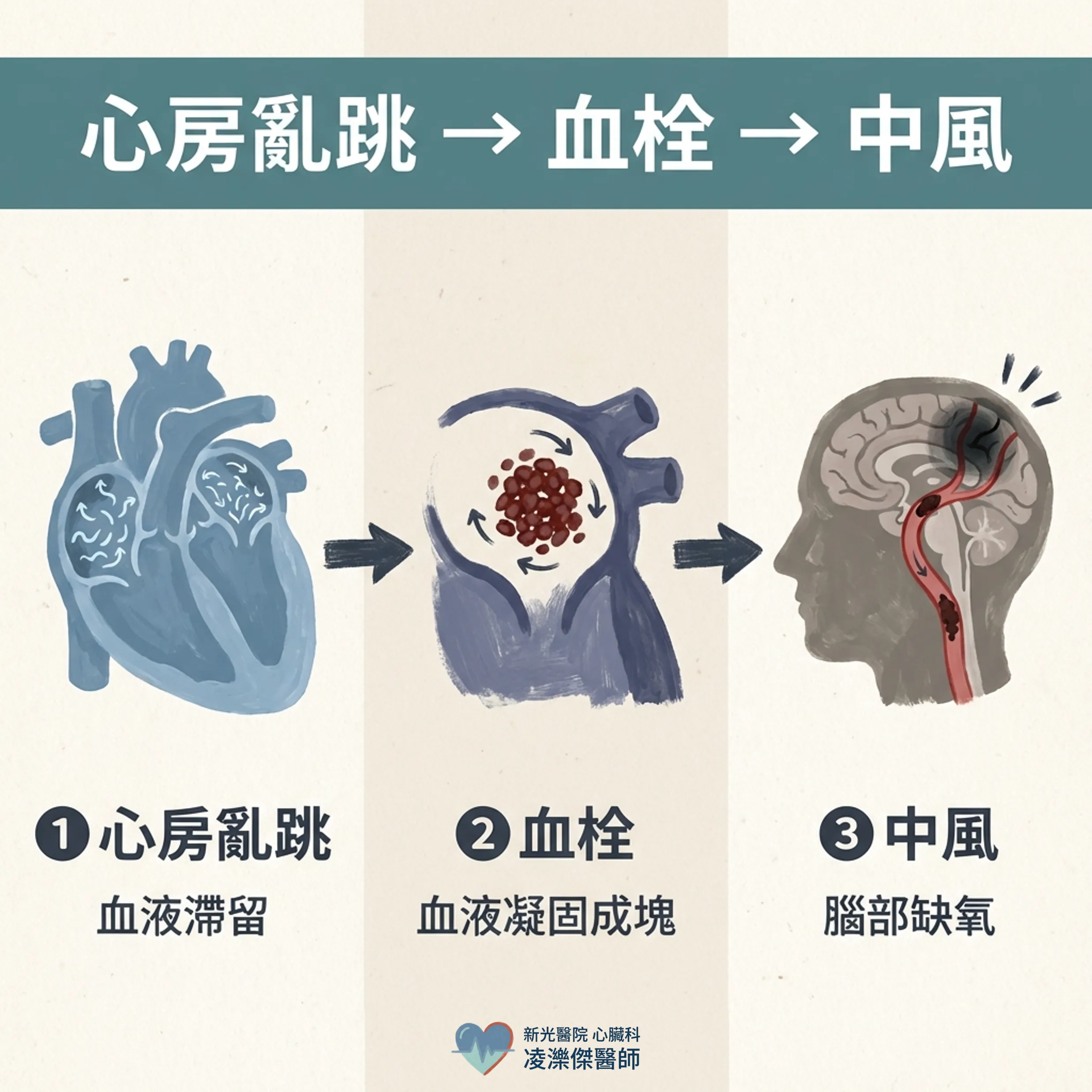 心房顫動:為什麼要吃抗凝血藥?不吃會怎樣? 圖卡 2