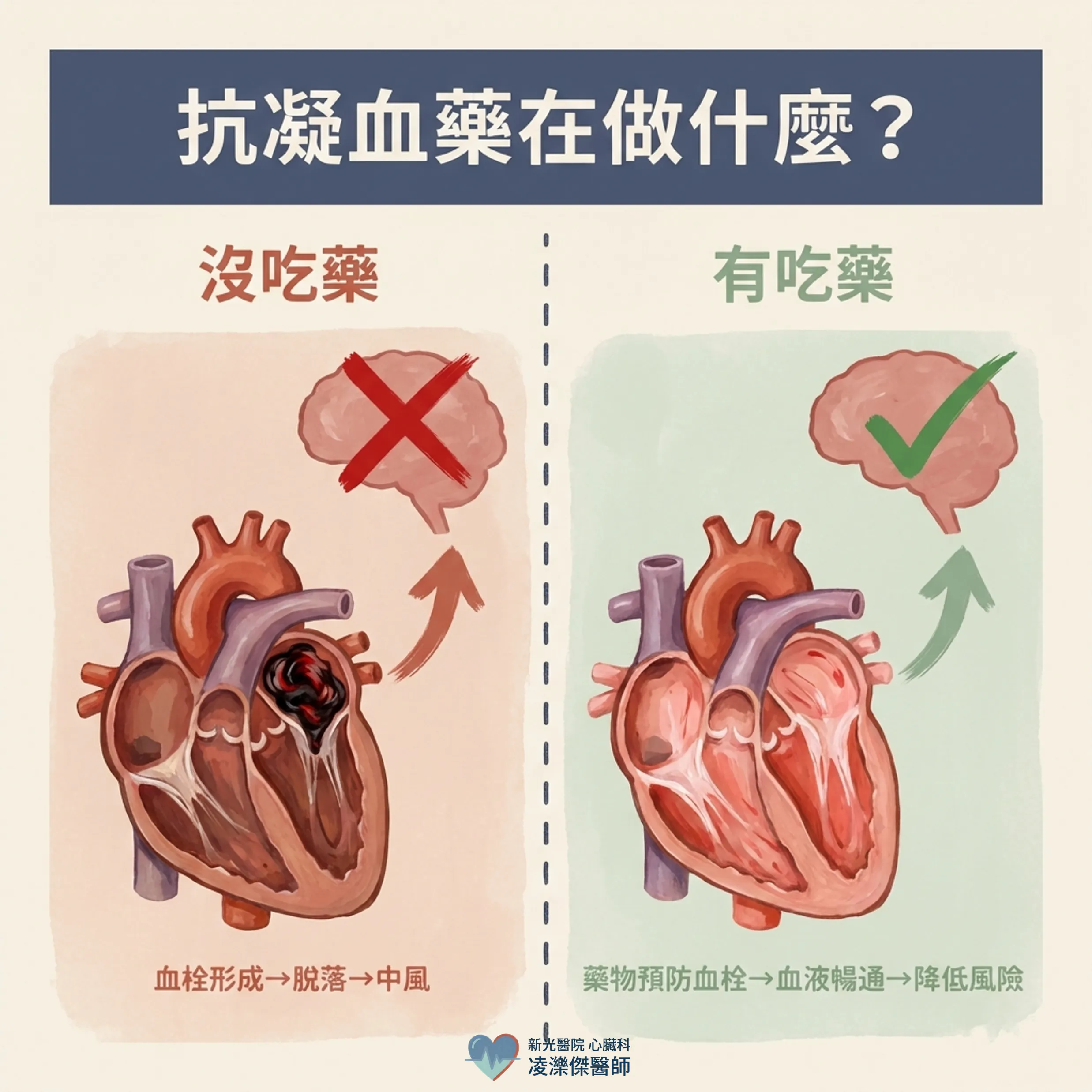 心房顫動:為什麼要吃抗凝血藥?不吃會怎樣? 圖卡 5