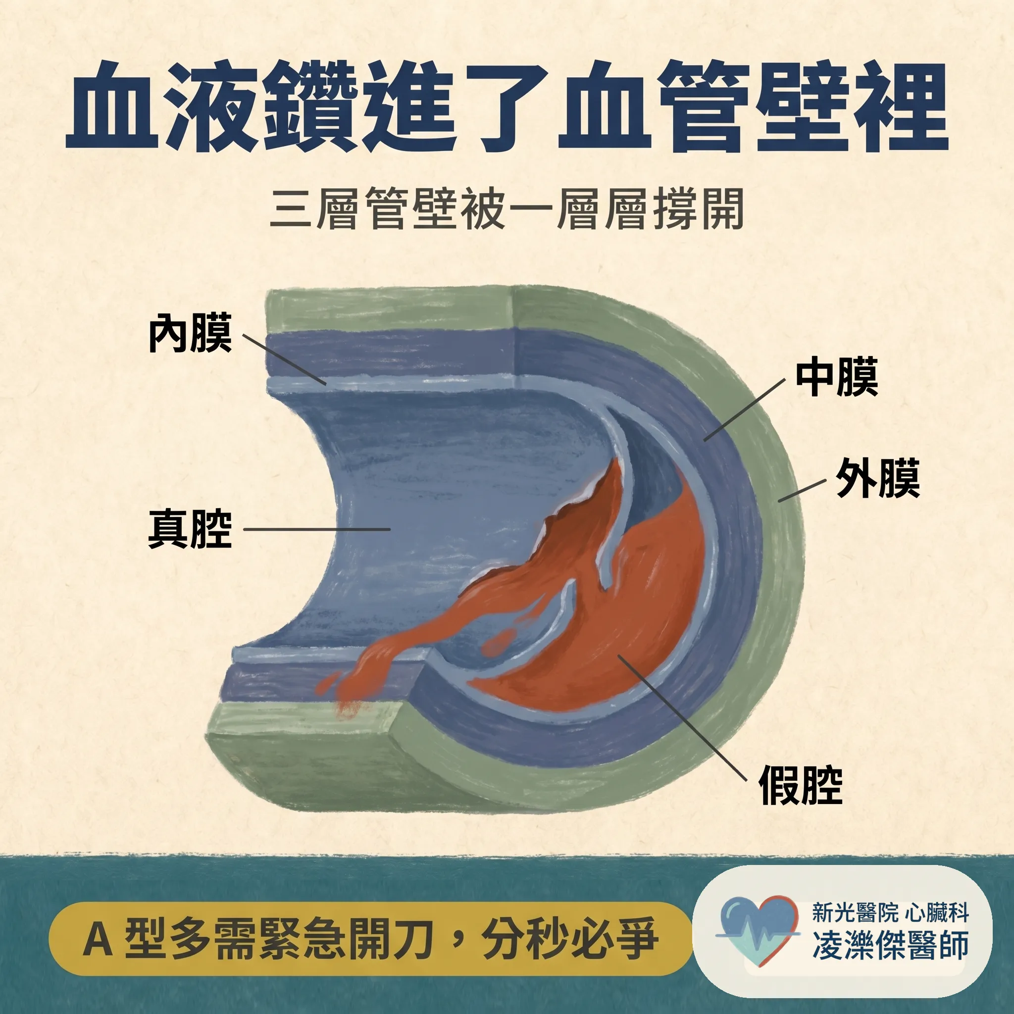 主動脈剝離:突然撕裂般的劇烈胸痛,一秒都不能等 圖卡 2