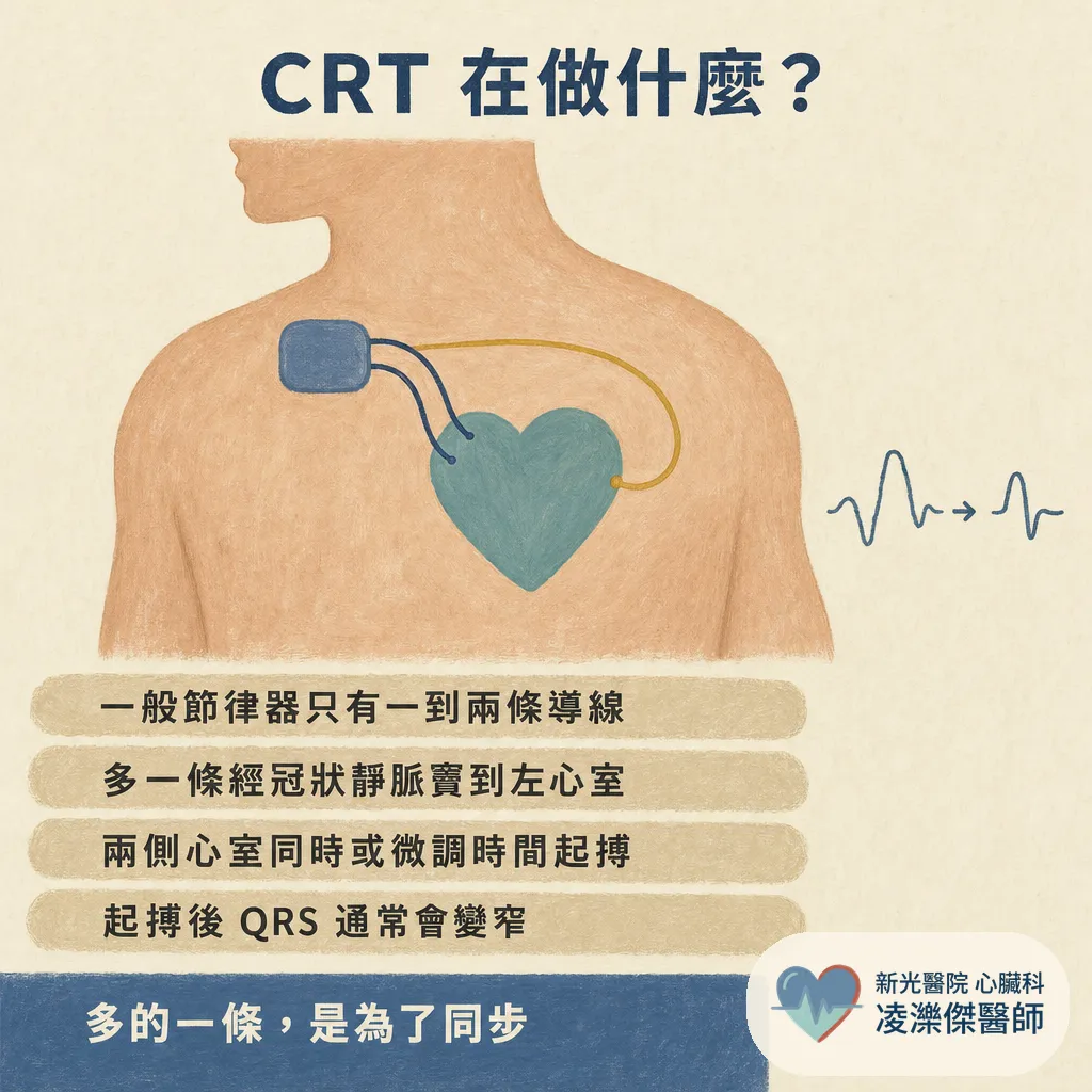 為什麼你需要心臟再同步治療(CRT)?藥都吃到位了還是喘,三條導線的節律器在做什麼 圖卡 4